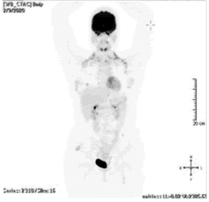 Race Oncology (ASX:RAC) - Patient after receiving Bisantrene