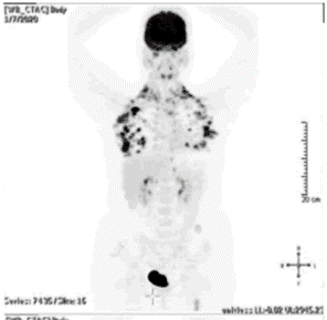 Race Oncology (ASX:RAC) - Patient before receiving Bisantrene